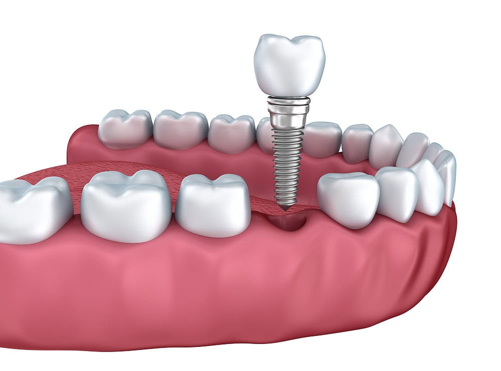 Dental Implant Costs - Ireland Grove Dental