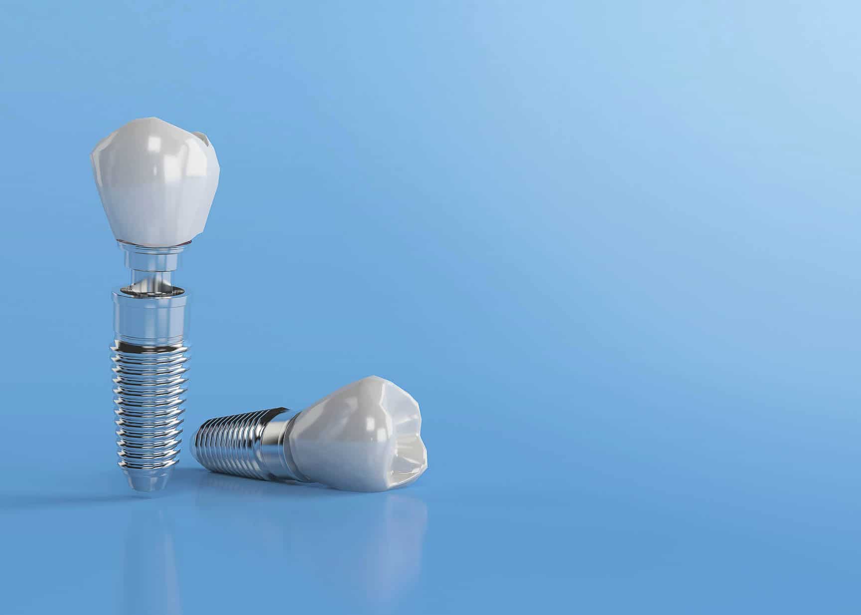 Dental Implant Placement - Ireland Grove Dental